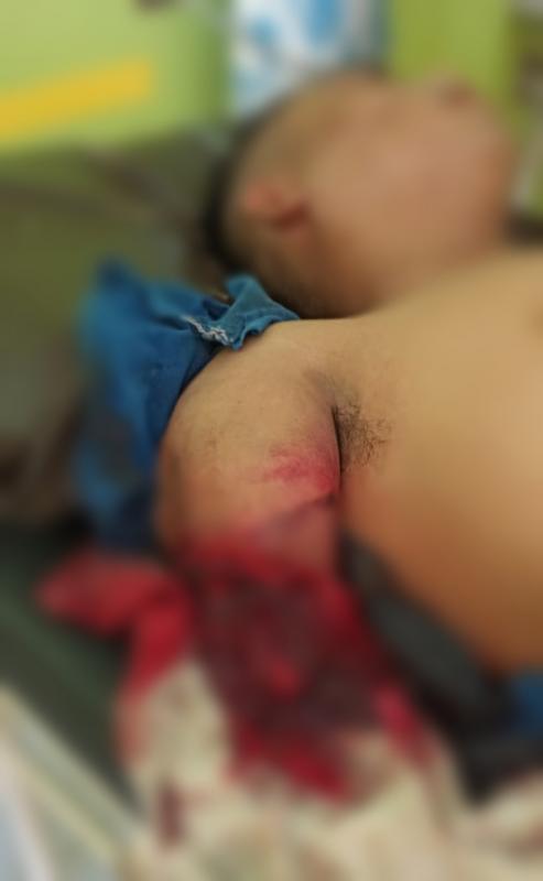 Aduh..Tangan Kanan Karyawan PT JGS Dusun Kerang Rohil Putus Digiling Mesin