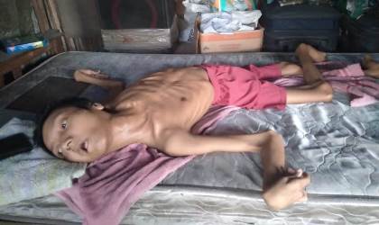 Anak Penderita Polio 30 Tahun di Riau Ini Butuh Bantuan