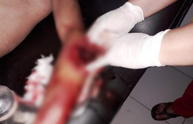 Kepergok Lagi Begituan, Suami di Sinjai Bacok Istri, Jari Nyaris Putus