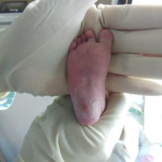 Diduga Malpraktek, Poldasu Periksa 3 Dokter RSU Mitra Medika Terkait Kaki Bayi Kader Demokrat Sumut "Melepuh"