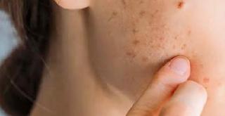 Inilah Cara Menghilangkan Beruntusan Dengan Cepat