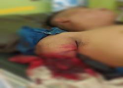 Aduh..Tangan Kanan Karyawan PT JGS Dusun Kerang Rohil Putus Digiling Mesin�