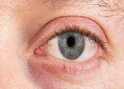 Waspada Mata Kering Bisa Menurunkan Produktivitas